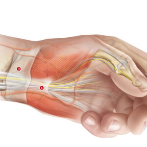 Die Strukturen so trainieren, dass sie wieder bequem unter dem Ringband Platz haben. Keiner würde einen Tunnel abreisen, wenn der Zug überladen ist