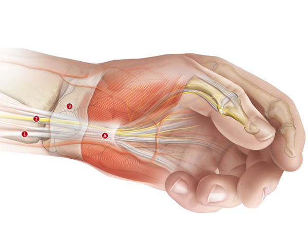 Die Strukturen so trainieren, dass sie wieder bequem unter dem Ringband Platz haben. Keiner würde einen Tunnel abreisen, wenn der Zug überladen ist